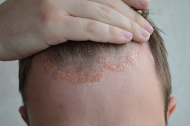 Dermatite Seborroica Come Curarla Con I Rimedi Naturali Ilgiornale It