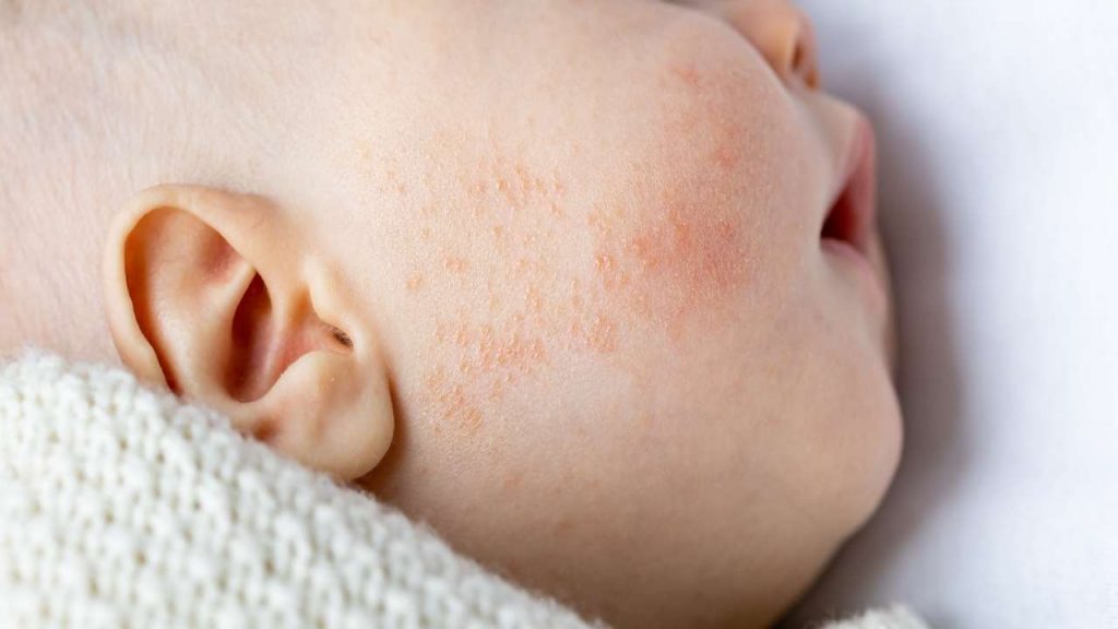 Dermatite Atopica Nei Bambini Le Conseguenze Psicologiche