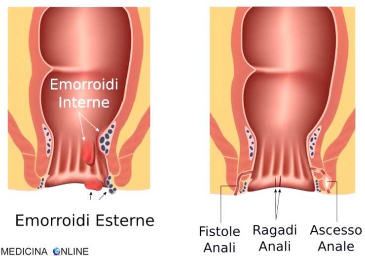 differenza tra ragadi e emorroidi - NonSapeviChe